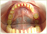 歯科治療症例